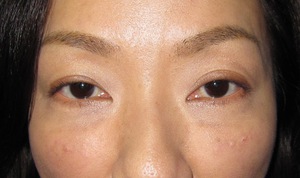 目の下のたるみ、目のくまでお悩みの方、切らずに完璧に解決します。TCB-R法　手術直後　症例写真
